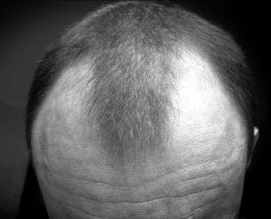Androgene Alopezie