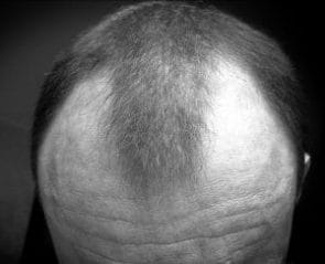 Androgene Alopezie