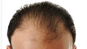 Androgene Alopezie