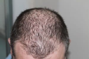 Alopezie